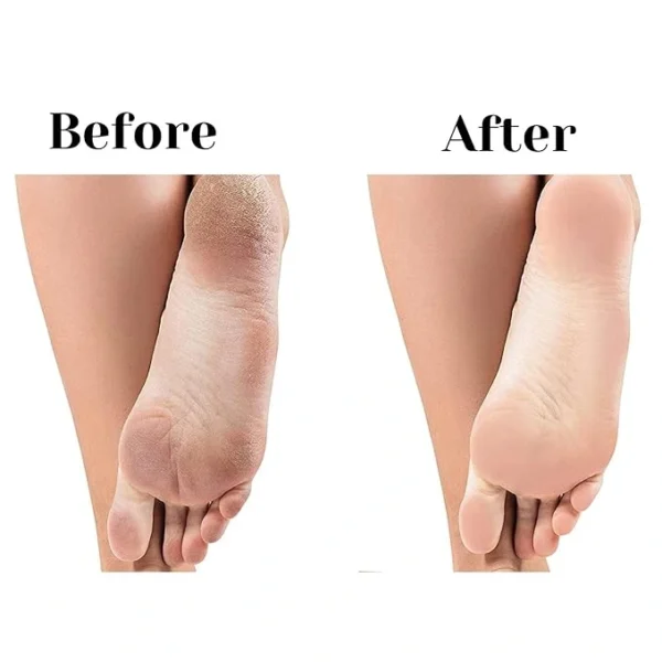 Equal Care for Feet: Protecting foot skin is as crucial as facial skincare Effective Foot Filing: Use a dual-action foot scrubber with rust-proof nickel material for smooth and callus-free feet Durable Design: Opt for quality materials and laser-cut grits for durability and safety Versatile Foot Scrubber: This 2-sided pedicure tool removes thick calluses and dry skin on wet and dry feet, providing baby-soft results Convenient and Non-Slip: The unique shape and non-slip handle make this foot scrubber perfect for home and travel use, saving time compared to electric foot files